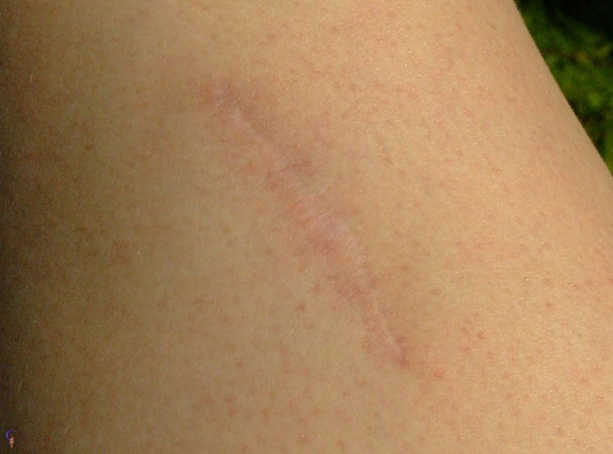 The scar may 2008.